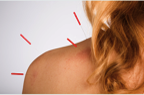 acupuncture for frozen shoulder pain and torn rotator cuff. 